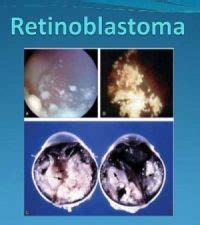 Retinoblastoma: Standard Treatment Guidelines