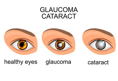 Cataracts Symptoms