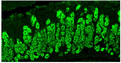 Improving the Diagnosis of Autoimmune Gastritis: From Parietal Cell ...