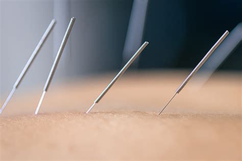 Dry needling - XPHYSIO