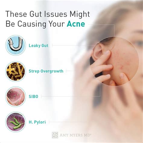 How Addressing Your Gut Can Help With Your Acne – AMMD