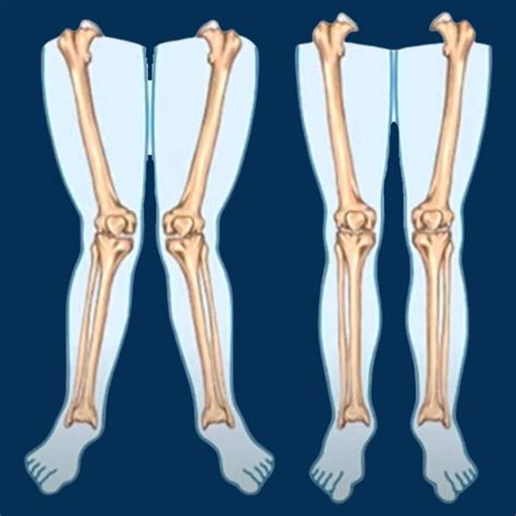What Causes Knock Knees In Adults at Jerry Demelo blog