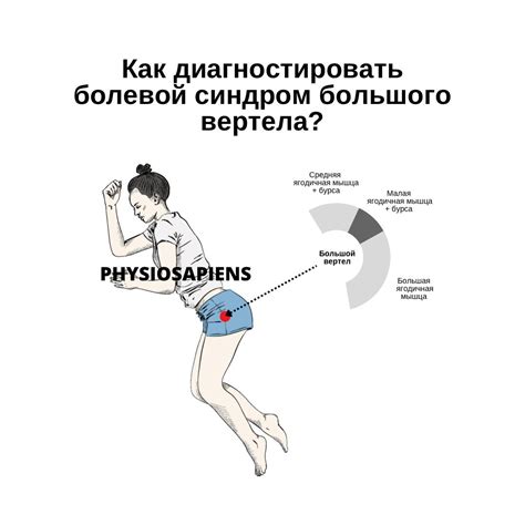 Как клинически диагностировать болевой синдром большого вертела ...