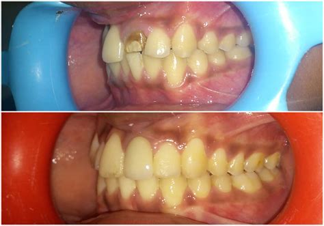 V CARE DENTAL HOME |FEATURED CASES