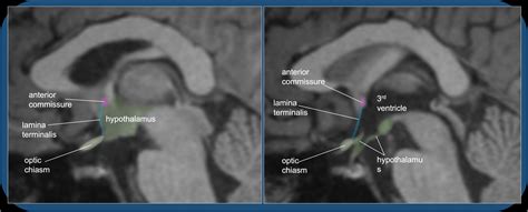 Image result for Lamina Terminalis Embryonic Development