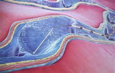 Mechanochemical ablation and cyanoacrylate adhesive have similar pain ...