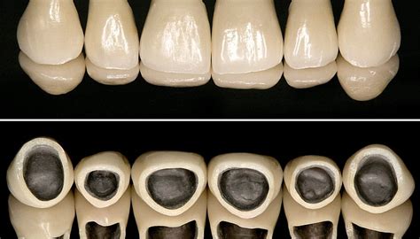 Dental Crowns : Types, cost and care | SmileWide