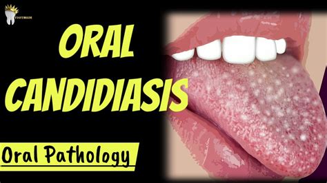 ORAL PATHOLOGY | ORAL CANDIDIASIS - YouTube