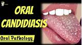 Oral Candidiasis: Video, Anatomy, Definition Function, 45% OFF
