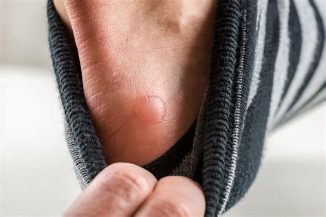 Friction Blisters: Here's How to Prevent and Treat Blisters | The Healthy