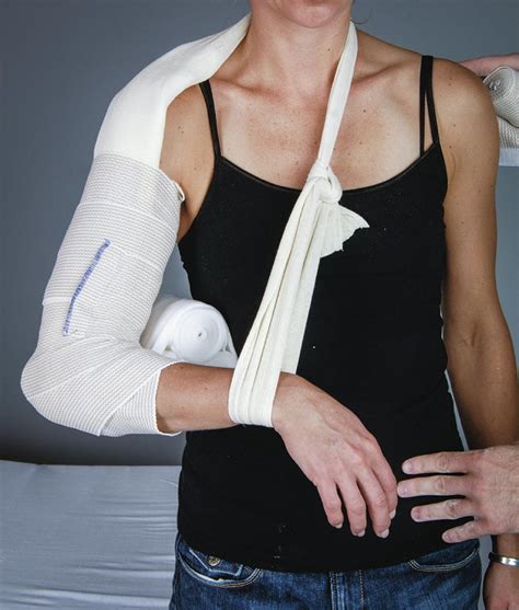 Types Of Upper Extremity Splints at Lily Smith blog