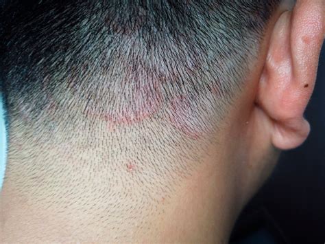 Salud: Todo lo que necesitas saber sobre la tiña: causas, síntomas y ...