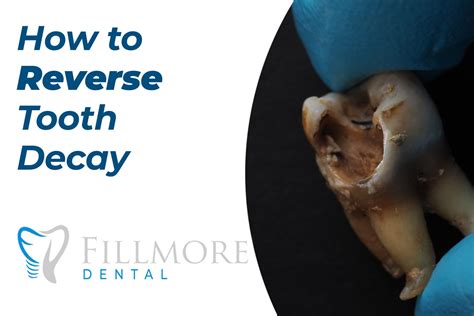 How To Reverse Tooth Decay