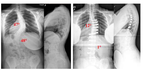 Degree Scoliosis Cervical Curve