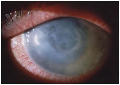 Understanding Acanthamoeba Keratitis: An In-Depth Review of a Sight ...