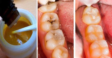 “ZAŠTO IMAM OVO NA ZUBIMA?” EVO KAKO DA GA SE RIJEŠITE SAMI: Potrebne ...