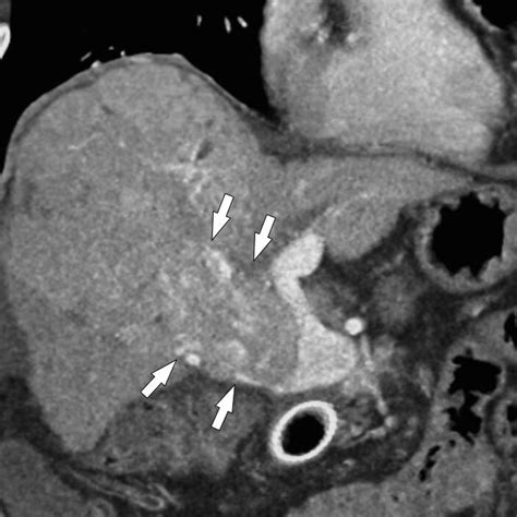 Pfortaderthrombose: Risikofaktoren, bildgebende Diagnostik, Komplikati ...
