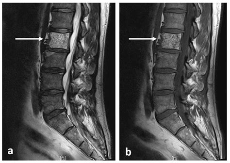 Lesions In Vertebrae