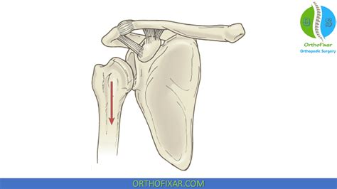 Image result for Sulcus Sign Shoulder
