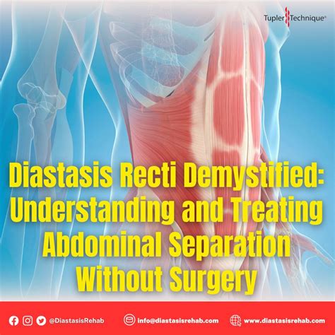 Diastasis Recti: Treating Abdominal Separation Without Surgery | Julie ...