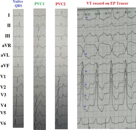 Image result for PVC ECG Reading