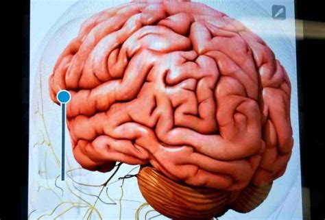 How does thalassemia affect the brain? - THIP Media