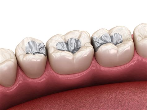 Best Dentists & Dental Clinic for Amalgam filling in , | Apollo Dental