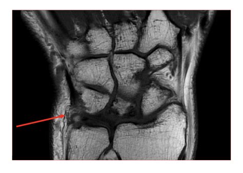 Mri Anatomy Wrist Radiology at Christy Redfield blog