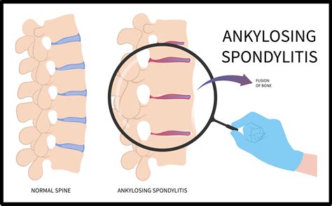 Ankylosing Spondylitis - OrthoEducation
