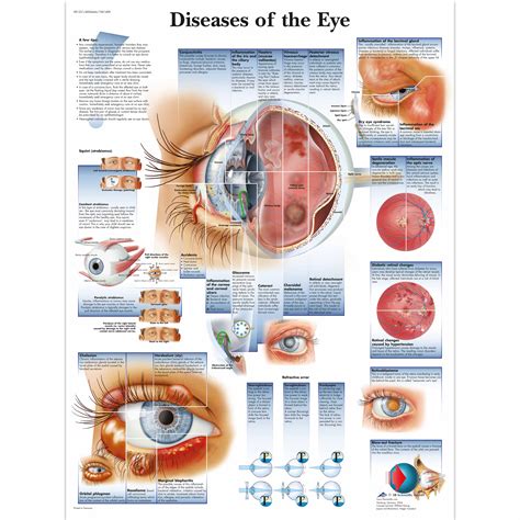 Diseases of the Eye Chart | 4006666 | 3B Scientific | VR1231UU ...