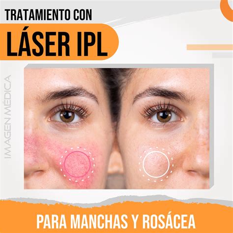 El tratamiento de la rosácea con láser IPL ( luz pulsada intensa)