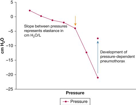 Pressure-Dependent Pneumothorax and Air Leak - CHEST