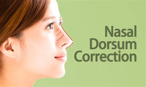 Nasal Dorsum Correction Care in Surat | Dr. Ashutosh Shah