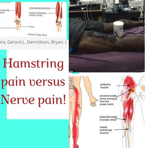 Hamstring strain vs. Nerve pain…