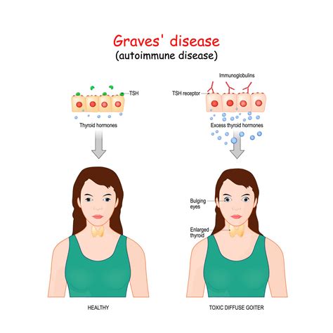 Thyroid Eye Disease (TED) Treatment in Chicago, IL | Kraff Eye Institute