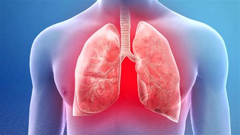 ARDS vs Pneumonia: Expert Shares Key Differences and What You Need to Know