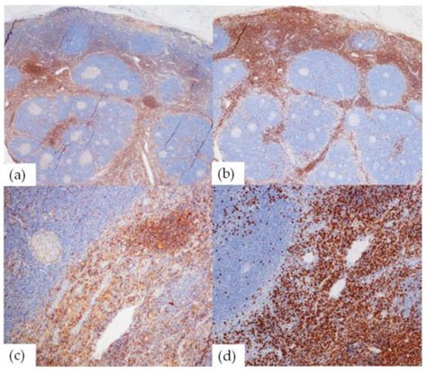 T-Cells Subsets in Castleman Disease: Analysis of 28 Cases Including ...
