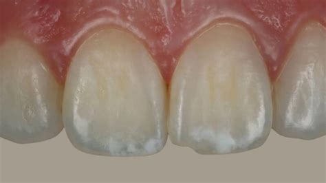 White Spot Removal on Teeth: Everything You Need to Know - Smile Stories