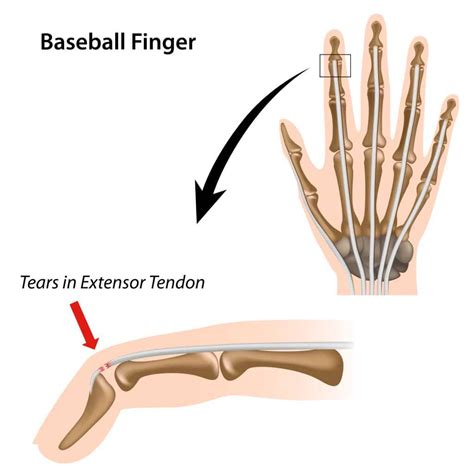 What Is A Partial Thickness Tear Of The Common Extensor Tendon at Ethel Waggener blog