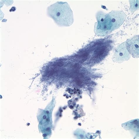 Fig. 2.61 Negative for intraepithelial lesion or malignancy (NILM). Bacteria morphologically ...