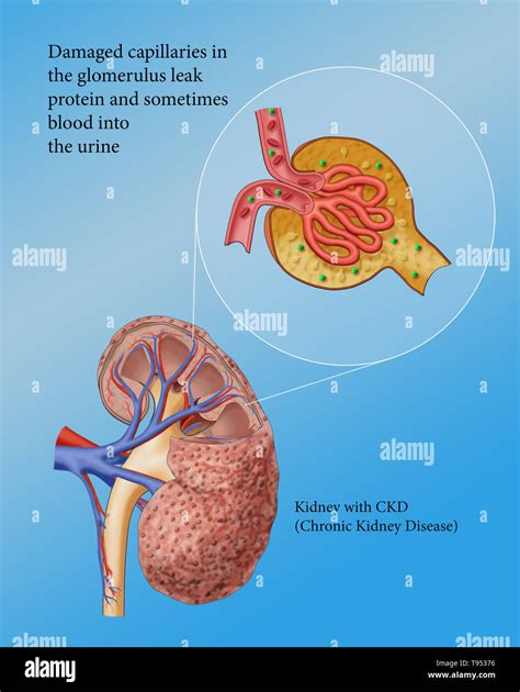 In chronic kidney disease (CKD) damaged capillaries in the glomerulus leak protein and sometimes ...