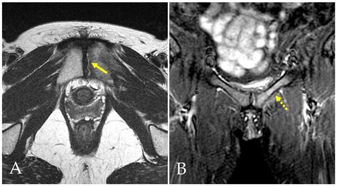 The Role of MRI in Groin Pain Syndrome in Athletes