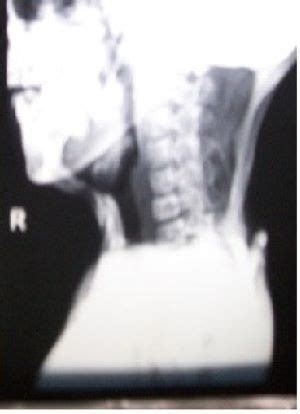 Mutlitple Soft Tissue Calcifications With Toe Deformities | Spot ...