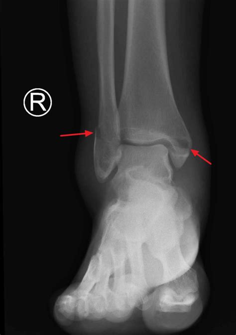 Bimalleolar fracture causes, symptoms,diagnosis, treatment & recovery