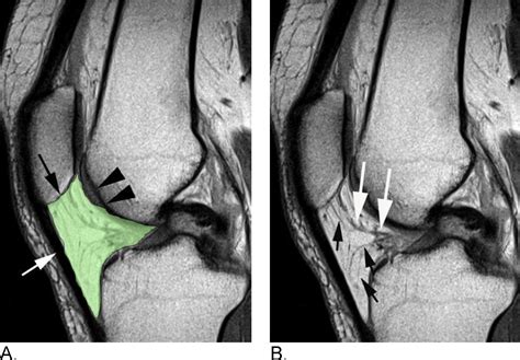 Magnetic resonance imaging of Hoffa's fat pad and relevance for ...