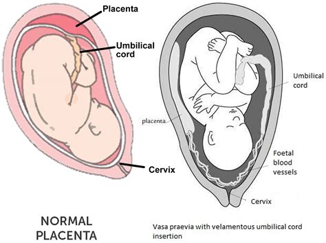 Velamentous cord insertion causes, risks, diagnosis & delivery