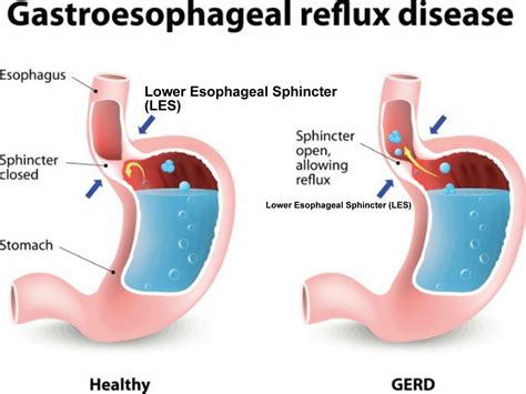 Heartburn, causes, symptoms, complications, diagnosis & treatment