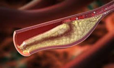 Rosuvastatin notably reduces carotid intima-media thickness progression ...