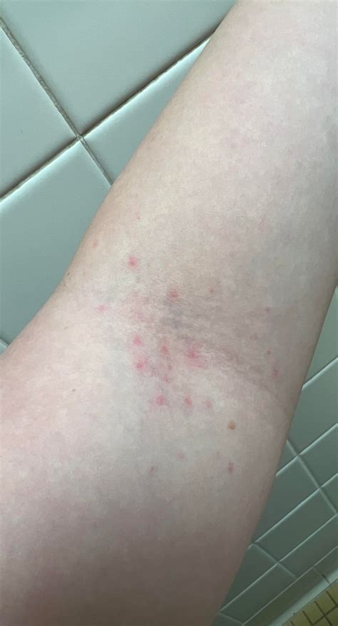 Small red bumps on inner elbow and underarm : r/DermatologyQuestions