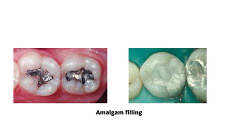 What Are The Types Of Amalgam Fillings at Natasha Mundt blog